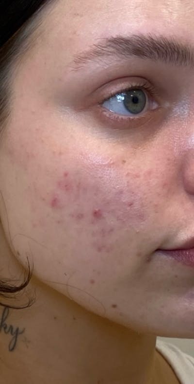 Skin Transformation Before & After Gallery - Patient 262728 - Image 1