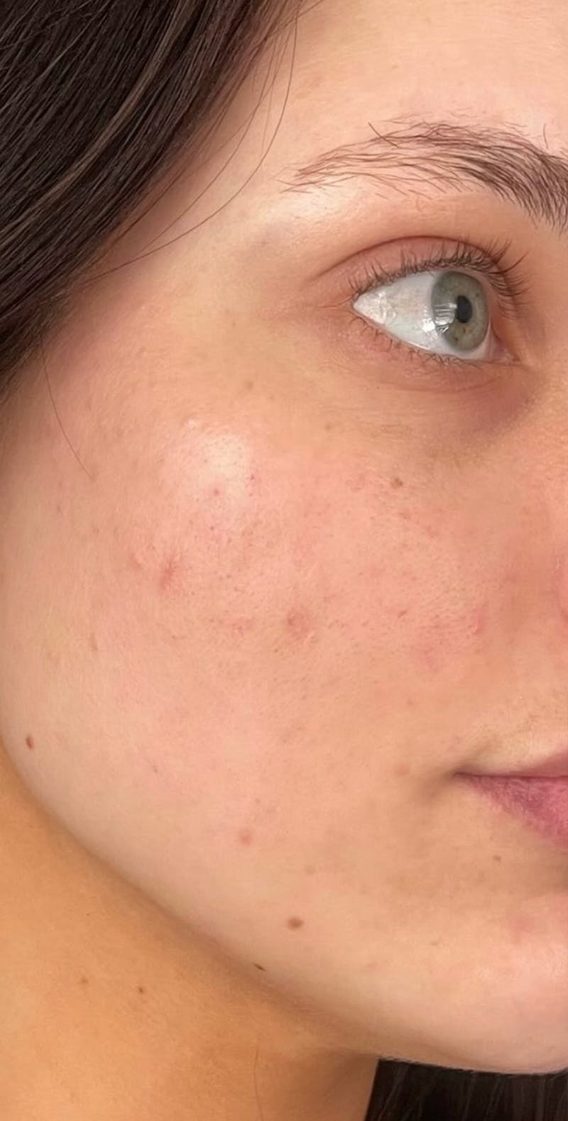 Skin Transformation Before & After Gallery - Patient 262728 - Image 2