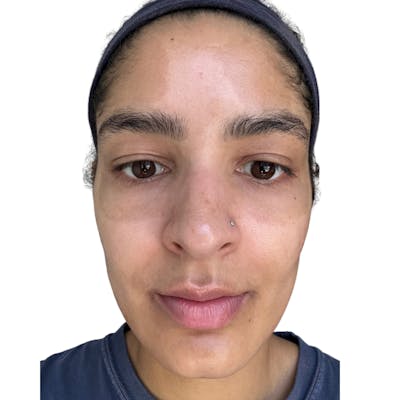 Skin Transformation Before & After Gallery - Patient 672878 - Image 1