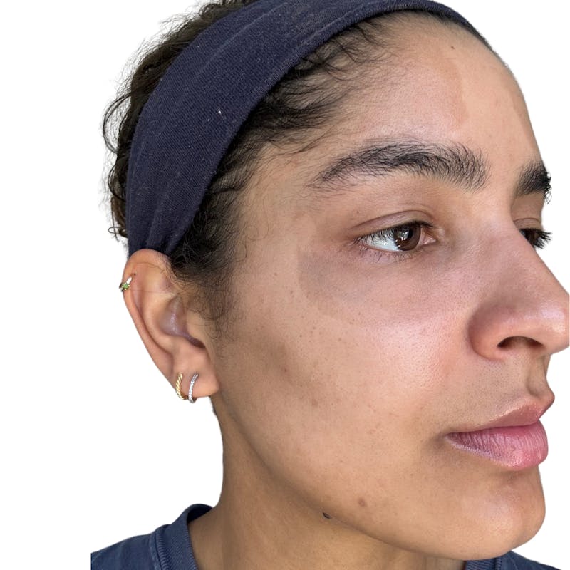 Skin Transformation Before & After Gallery - Patient 672878 - Image 3