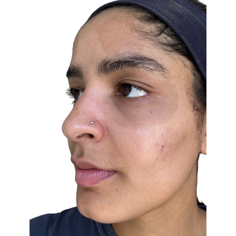 Skin Transformation Before & After Gallery - Patient 672878 - Image 5
