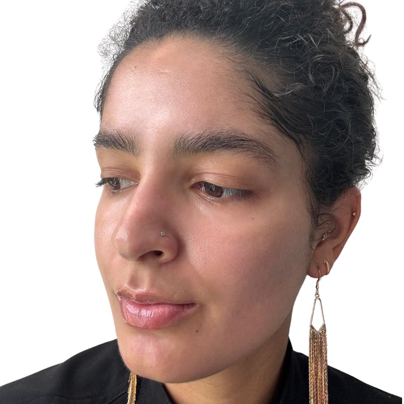 Skin Transformation Before & After Gallery - Patient 672878 - Image 6