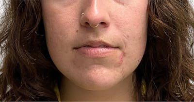 Skin Transformation Before & After Gallery - Patient 358091 - Image 1