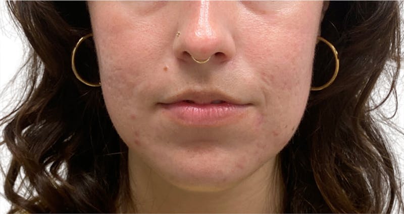 Skin Transformation Before & After Gallery - Patient 358091 - Image 2