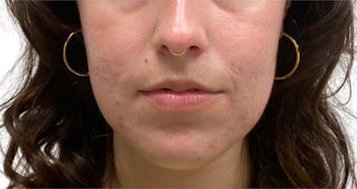 Skin Transformation Before & After Gallery - Patient 358091 - Image 2