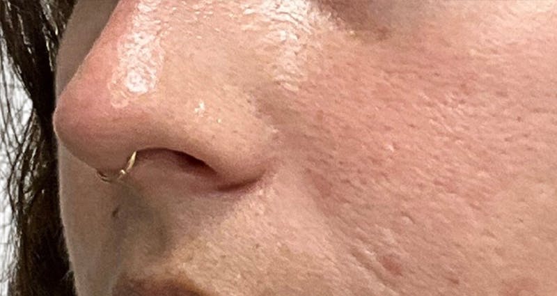 Skin Transformation Before & After Gallery - Patient 358091 - Image 3