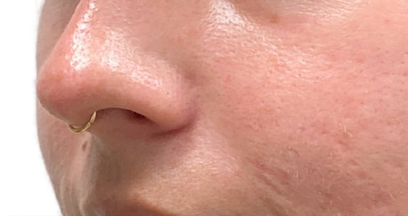 Skin Transformation Before & After Gallery - Patient 358091 - Image 4