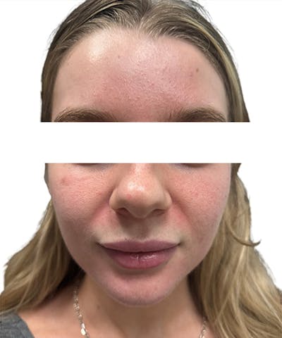 Skin Transformation Before & After Gallery - Patient 212671 - Image 1