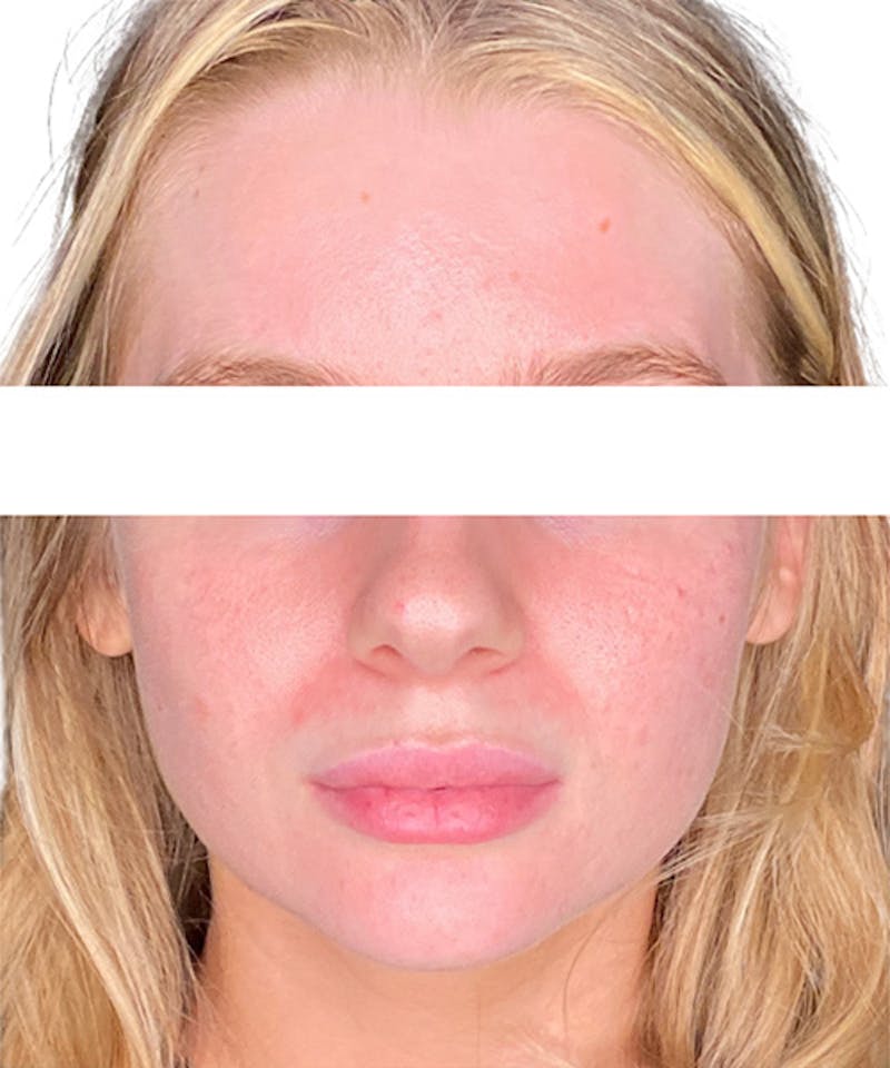 Skin Transformation Before & After Gallery - Patient 212671 - Image 2