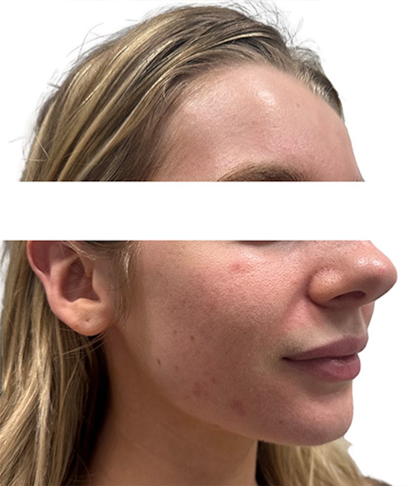 Skin Transformation Before & After Gallery - Patient 212671 - Image 3