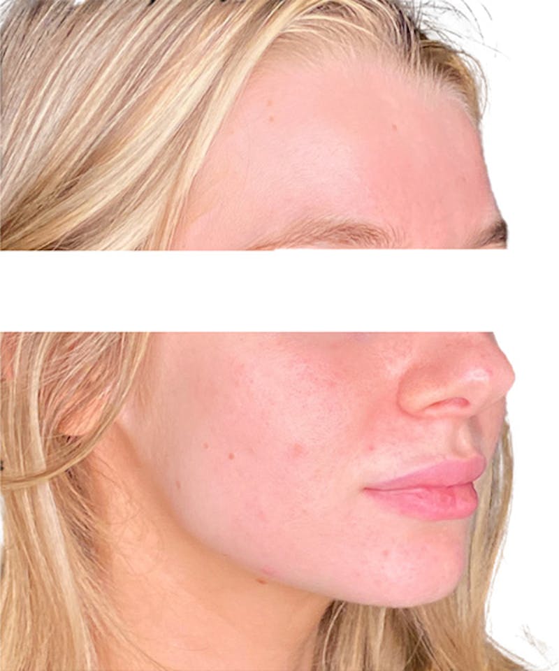 Skin Transformation Before & After Gallery - Patient 212671 - Image 4