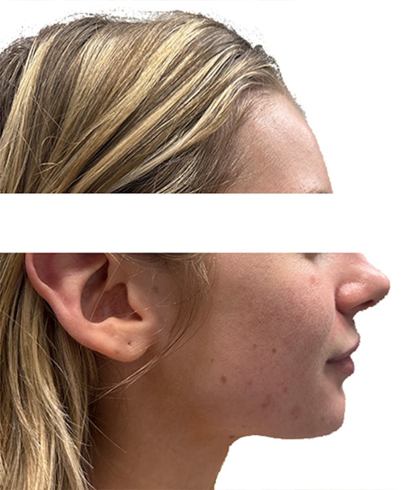 Skin Transformation Before & After Gallery - Patient 212671 - Image 5