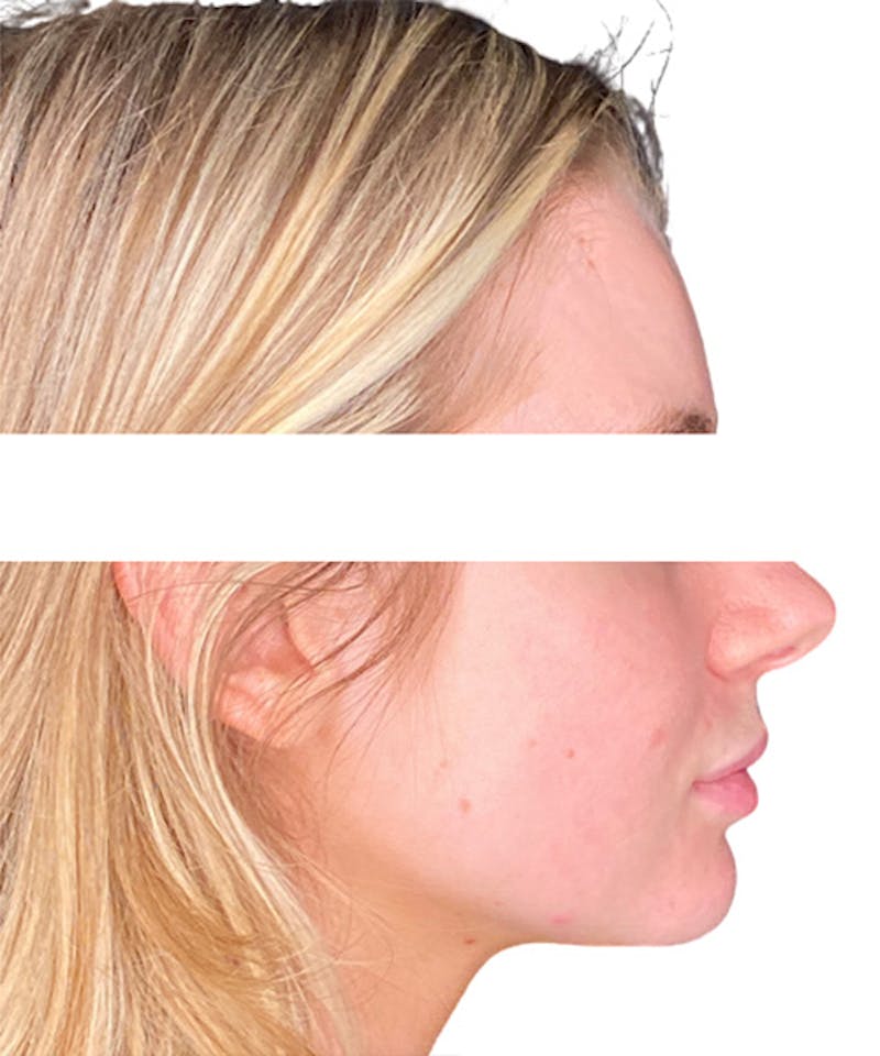 Skin Transformation Before & After Gallery - Patient 212671 - Image 6