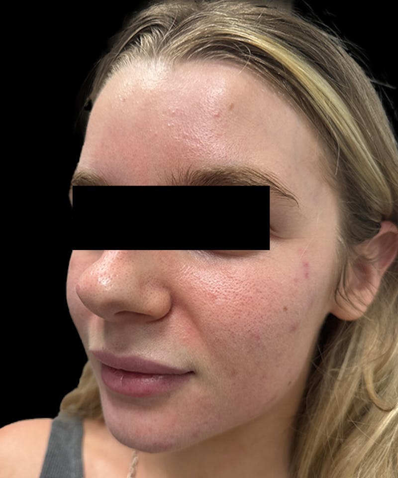 Skin Transformation Before & After Gallery - Patient 212671 - Image 7