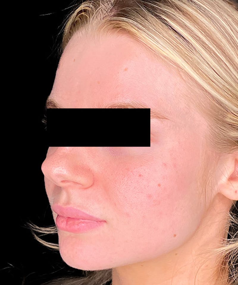 Skin Transformation Before & After Gallery - Patient 212671 - Image 8
