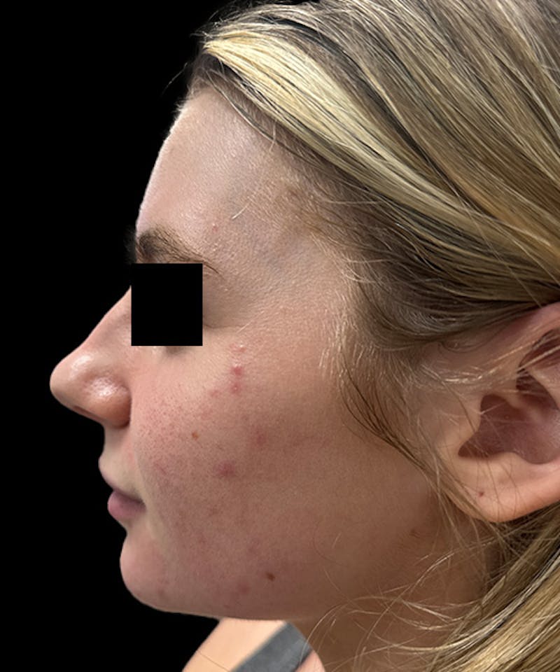 Skin Transformation Before & After Gallery - Patient 212671 - Image 9