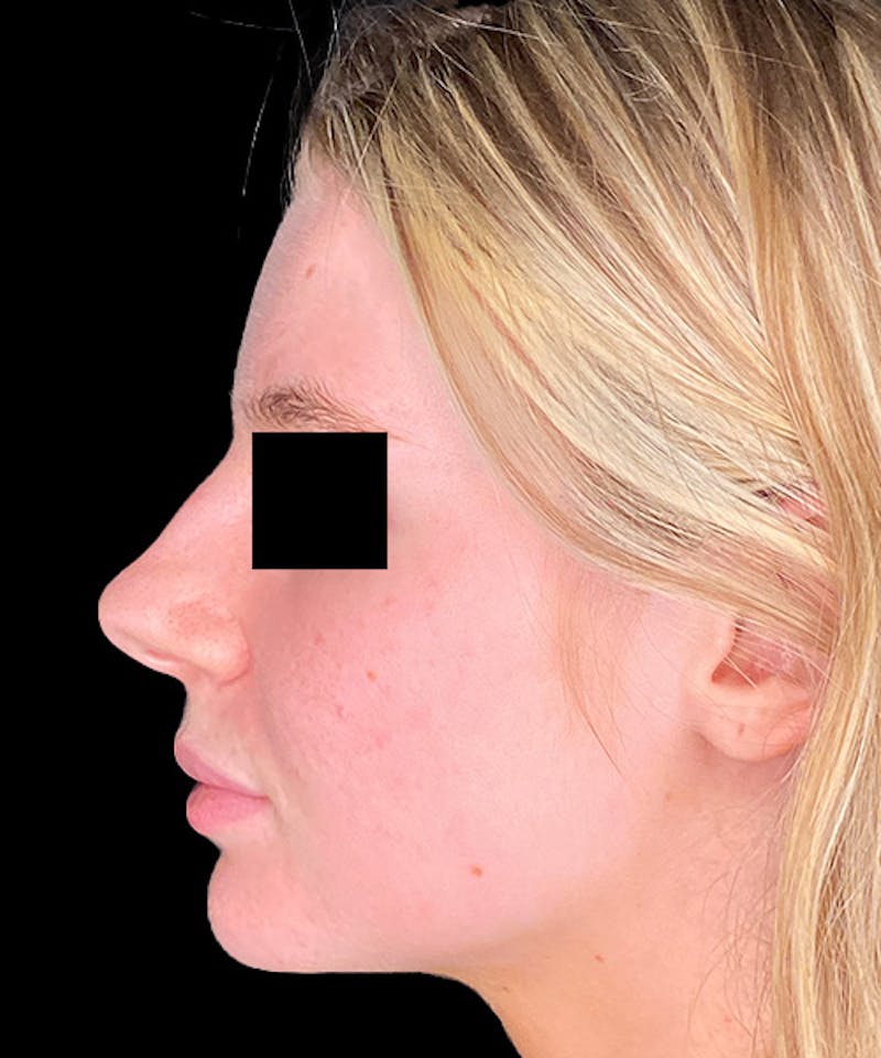 Skin Transformation Before & After Gallery - Patient 212671 - Image 10