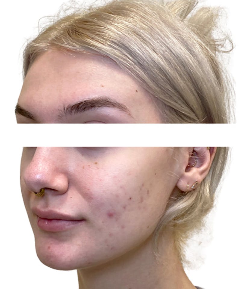 Skin Transformation Before & After Gallery - Patient 280084 - Image 1