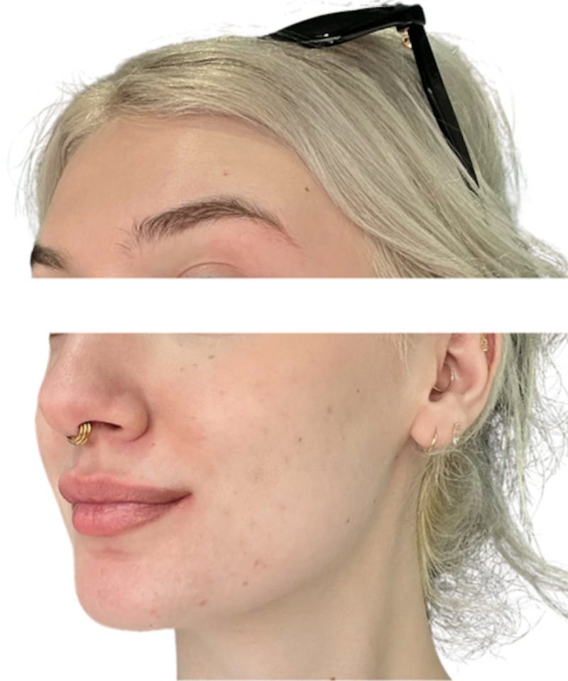 Skin Transformation Before & After Gallery - Patient 280084 - Image 2
