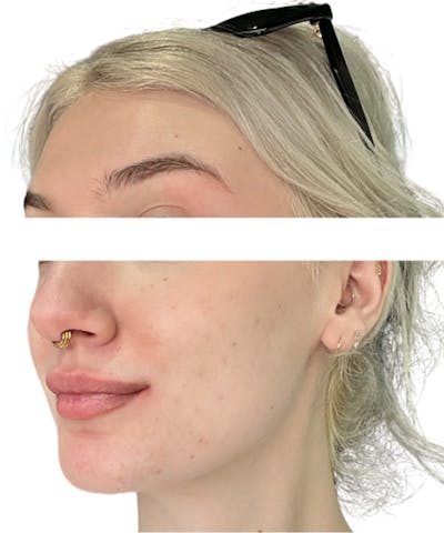 Skin Transformation Before & After Gallery - Patient 280084 - Image 2
