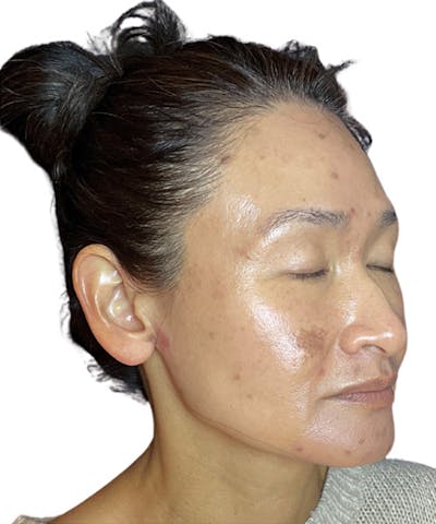 Skin Transformation Before & After Gallery - Patient 417405 - Image 1