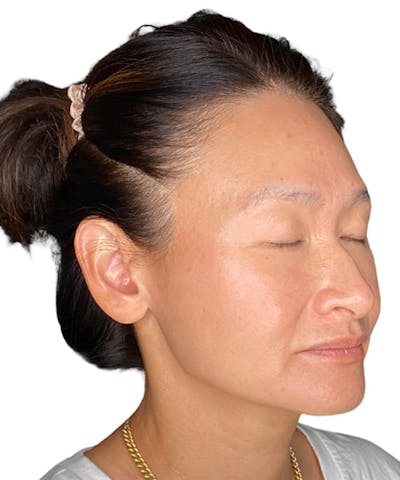 Skin Transformation Before & After Gallery - Patient 417405 - Image 2