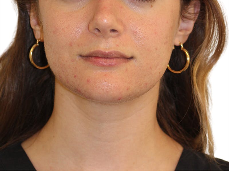 Skin Transformation Before & After Gallery - Patient 294102 - Image 1