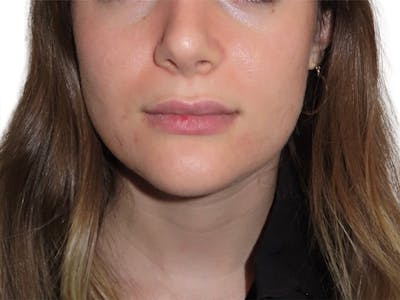 Skin Transformation Before & After Gallery - Patient 294102 - Image 2
