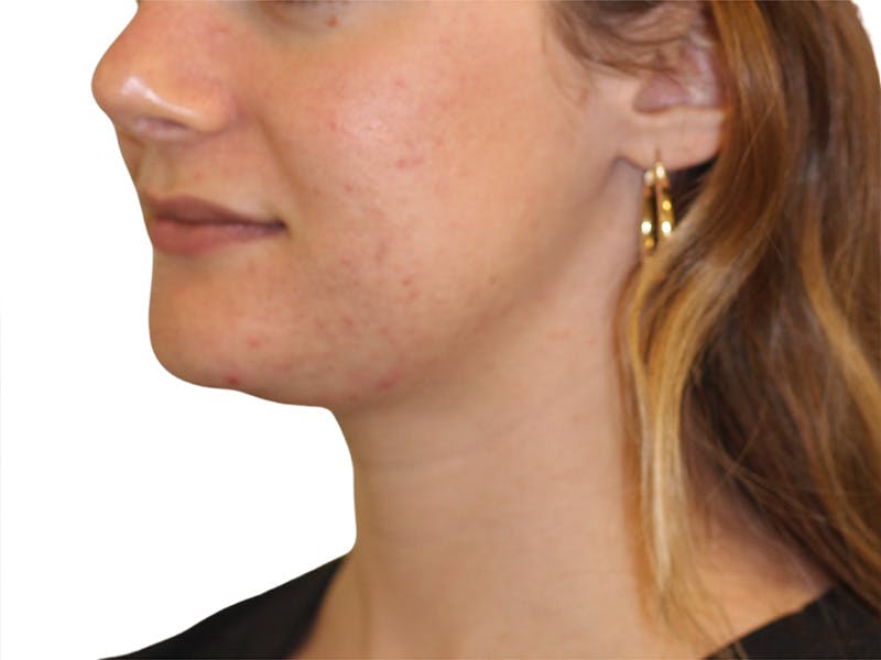 Skin Transformation Before & After Gallery - Patient 294102 - Image 3