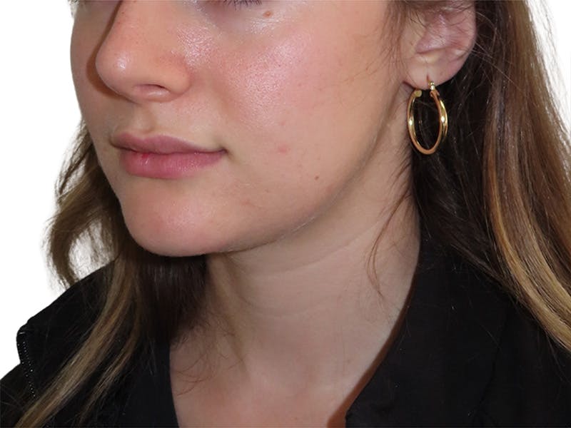 Skin Transformation Before & After Gallery - Patient 294102 - Image 4