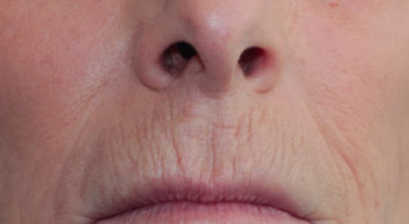 Skin Transformation Before & After Gallery - Patient 178371 - Image 1