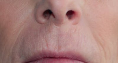 Skin Transformation Before & After Gallery - Patient 178371 - Image 2