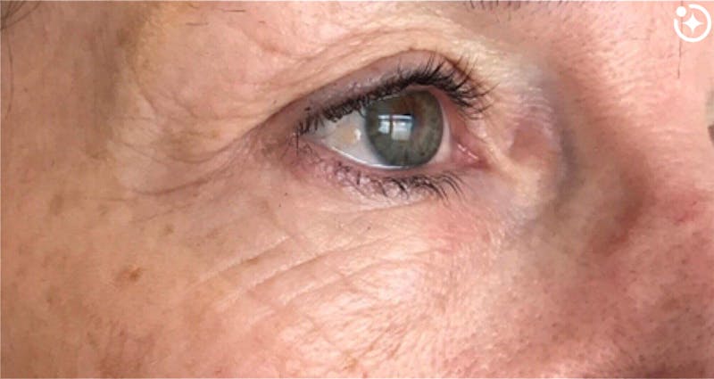 Skin Transformation Before & After Gallery - Patient 171589 - Image 1