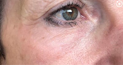 Skin Transformation Before & After Gallery - Patient 171589 - Image 2
