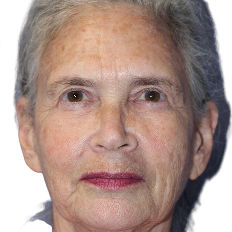 Skin Transformation Before & After Gallery - Patient 314494 - Image 1