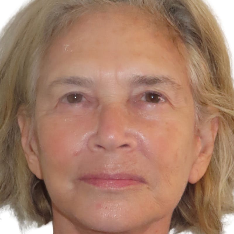 Skin Transformation Before & After Gallery - Patient 314494 - Image 2