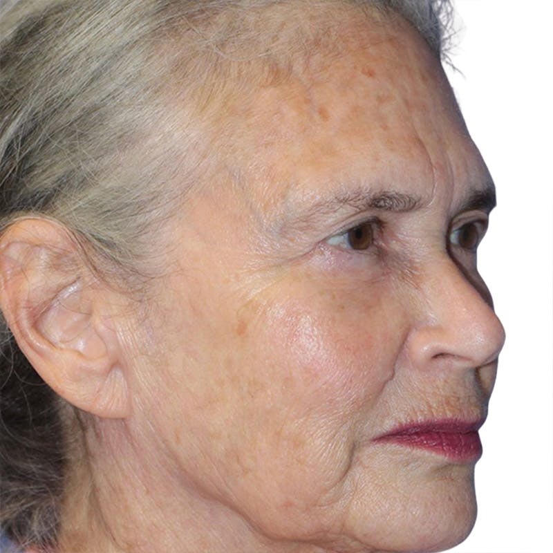 Skin Transformation Before & After Gallery - Patient 314494 - Image 3