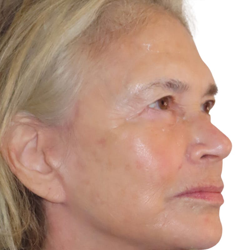 Skin Transformation Before & After Gallery - Patient 314494 - Image 4