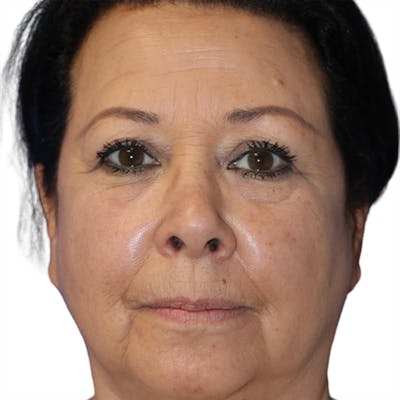 Skin Transformation Before & After Gallery - Patient 171447 - Image 1