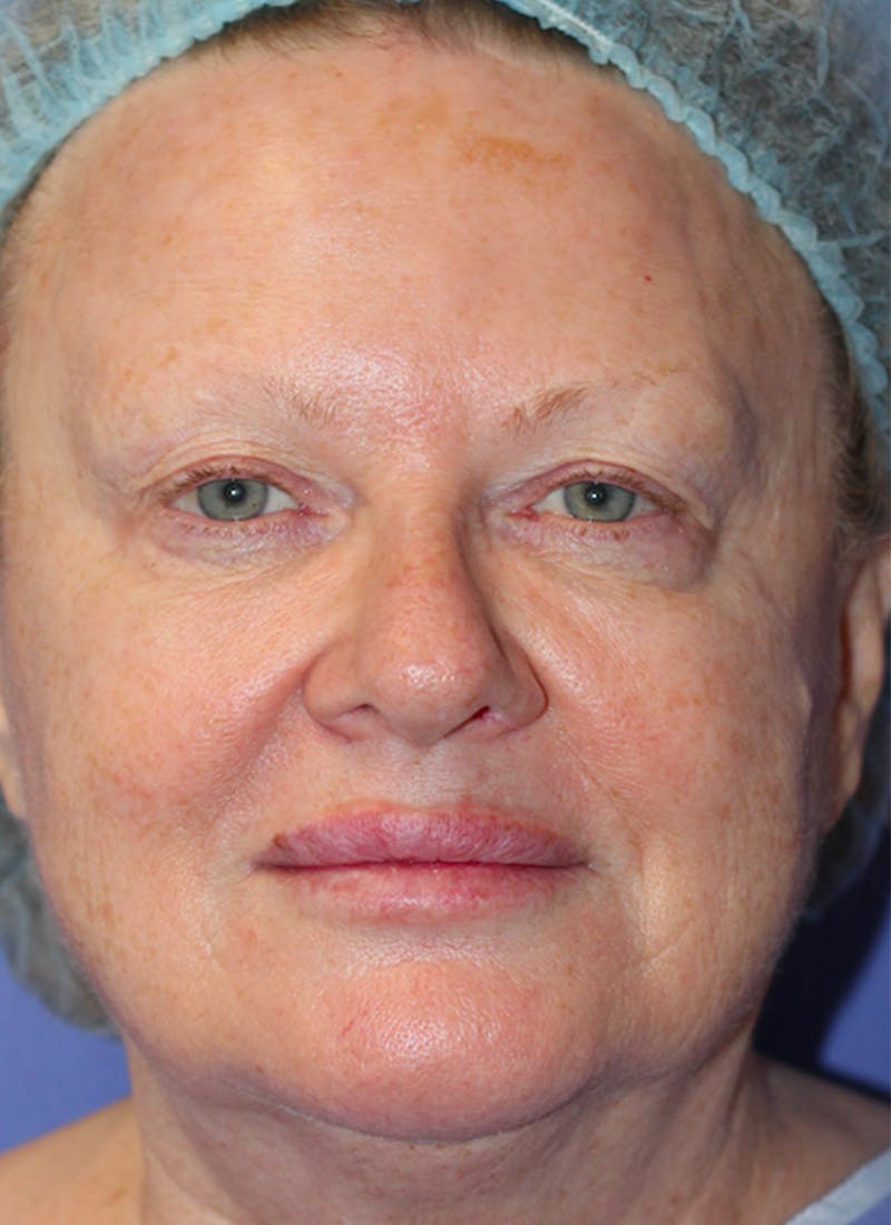 Skin Transformation Before & After Gallery - Patient 556250 - Image 1