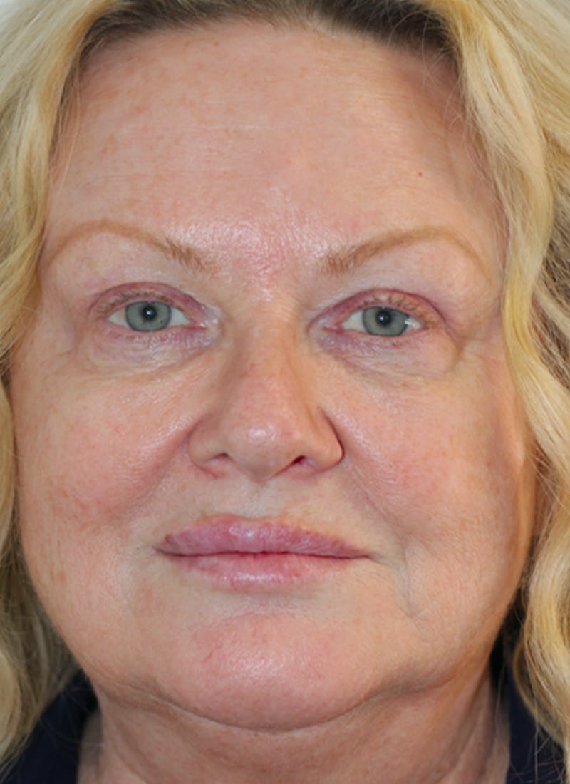 Skin Transformation Before & After Gallery - Patient 556250 - Image 2