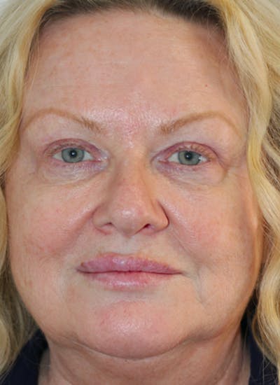 Skin Transformation Before & After Gallery - Patient 556250 - Image 2