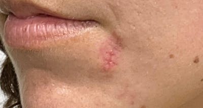 Scar Care Before & After Gallery - Patient 397868 - Image 1