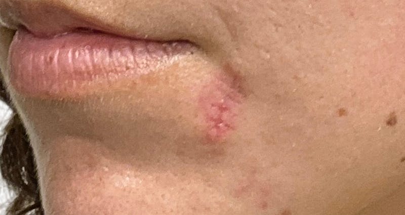 Scar Care Before & After Gallery - Patient 397868 - Image 1