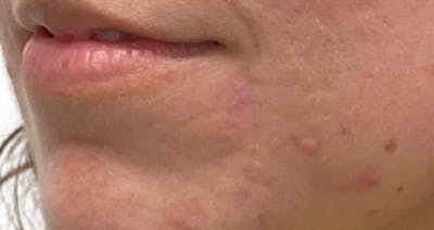Scar Care Before & After Gallery - Patient 397868 - Image 2
