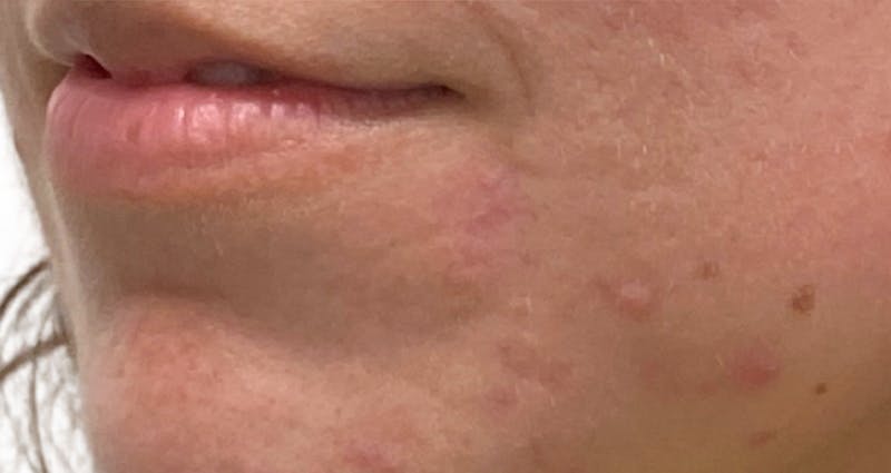 Scar Care Before & After Gallery - Patient 397868 - Image 2