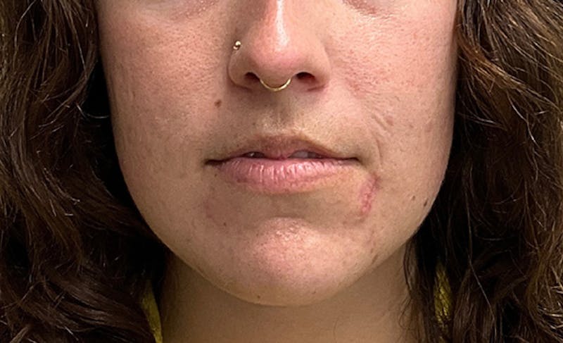 Scar Care Before & After Gallery - Patient 397868 - Image 3