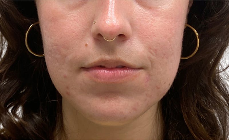 Scar Care Before & After Gallery - Patient 397868 - Image 4