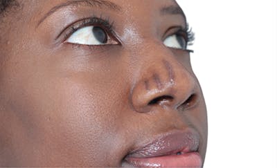 Scar Care Before & After Gallery - Patient 392892 - Image 1