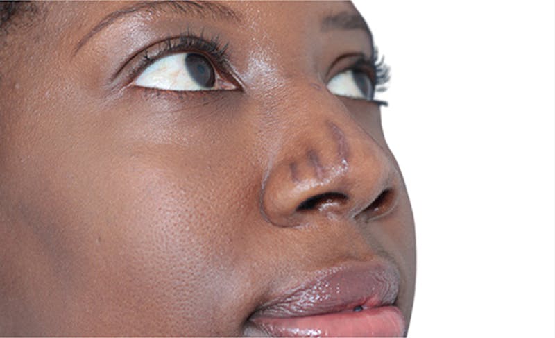 Scar Care Before & After Gallery - Patient 392892 - Image 1